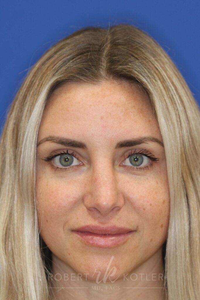 rhinoplasty-beverly-hills-ca-20299