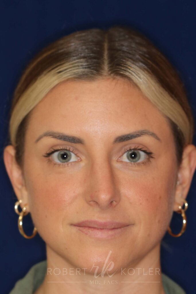 rhinoplasty-beverly-hills-ca-20300