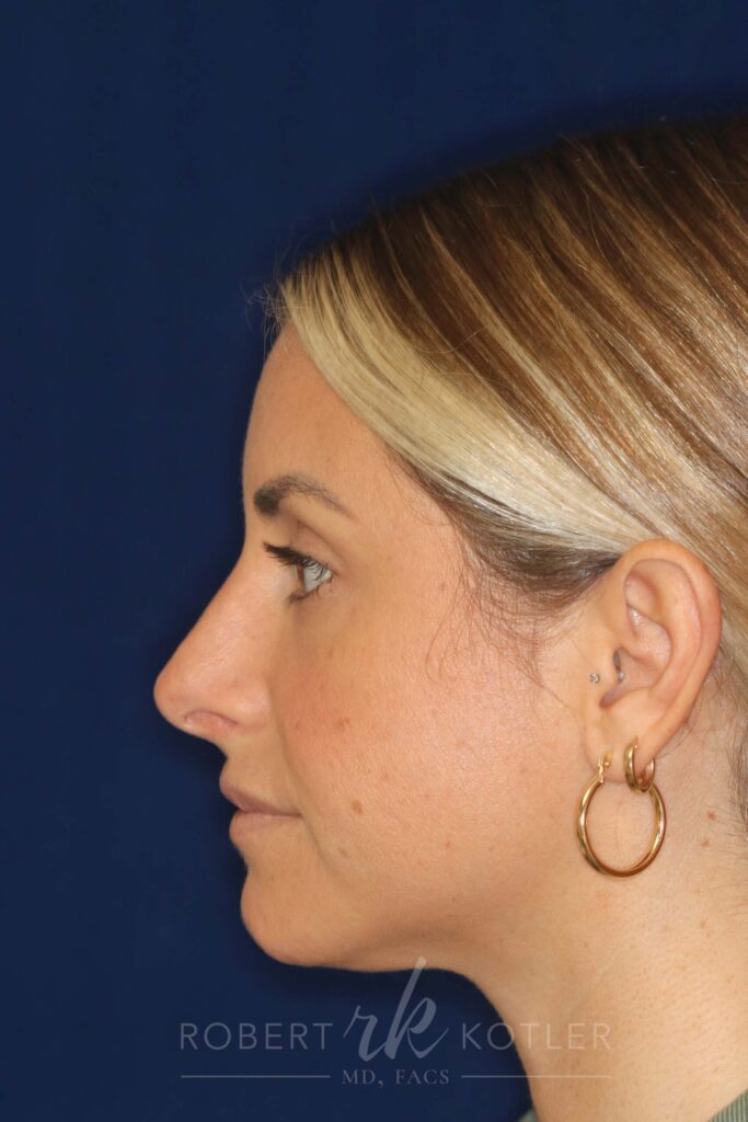 rhinoplasty-beverly-hills-ca-20302