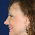 Closed Rhinoplasty - Left Profile - After Pic - Bump completely removed, tip recessed and refined - Nose Job in Beverly Hills