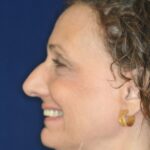Closed Rhinoplasty - Left Profile - Before Pic - Bump to be removed and recess tip - Best Rhinoplasty Beverly Hills