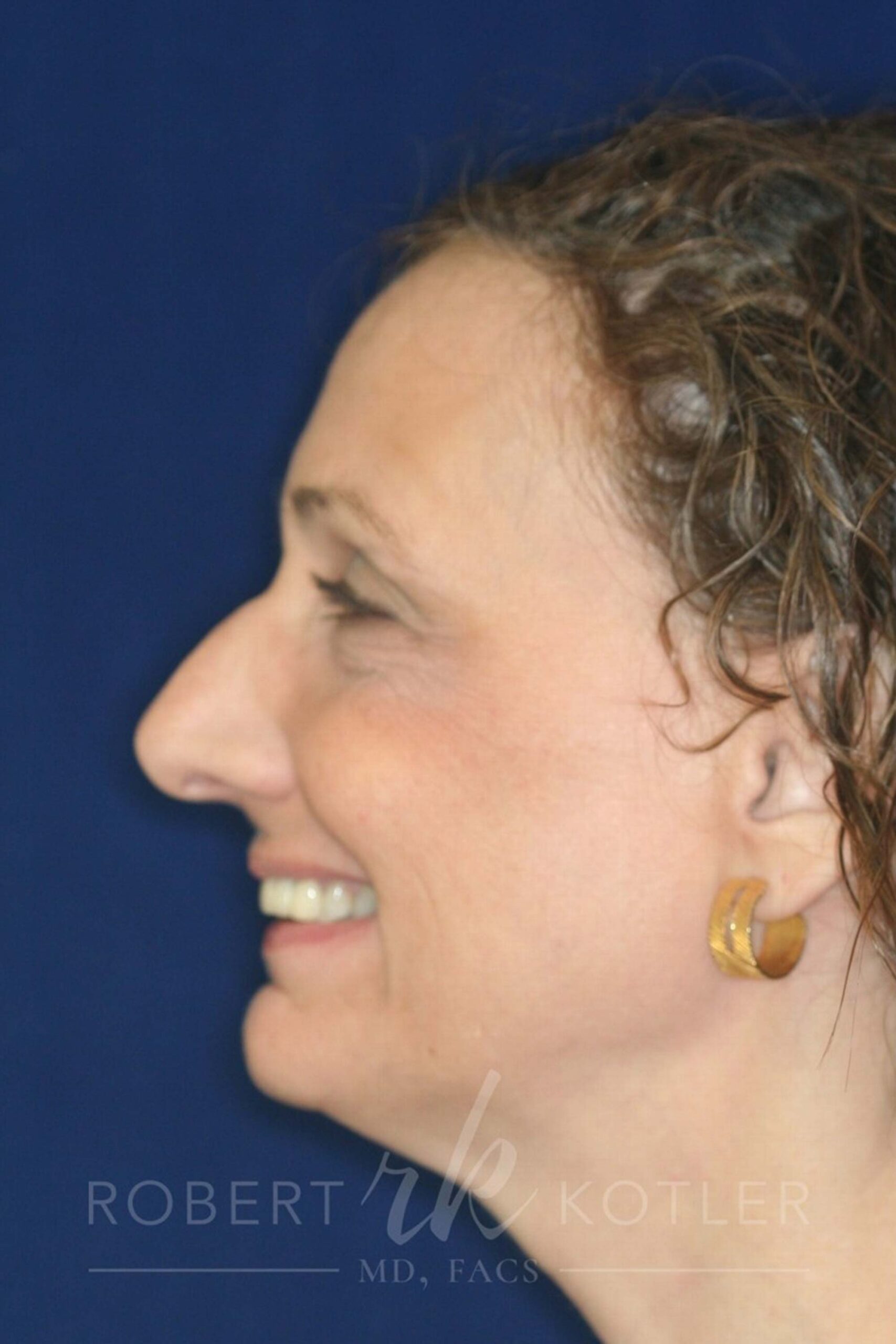 Closed Rhinoplasty - Left Profile - Before Pic - Bump to be removed and recess tip - Best Rhinoplasty Beverly Hills