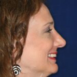 Closed Rhinoplasty - Right Profile - After Pic - Bump fully removed - Recessed and refined tip - The Top Rhinoplasty Surgeon