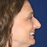 Closed Rhinoplasty - Right Profile - Before Pic - Bump to be removed and recess tip - Best Nose Job Surgeon