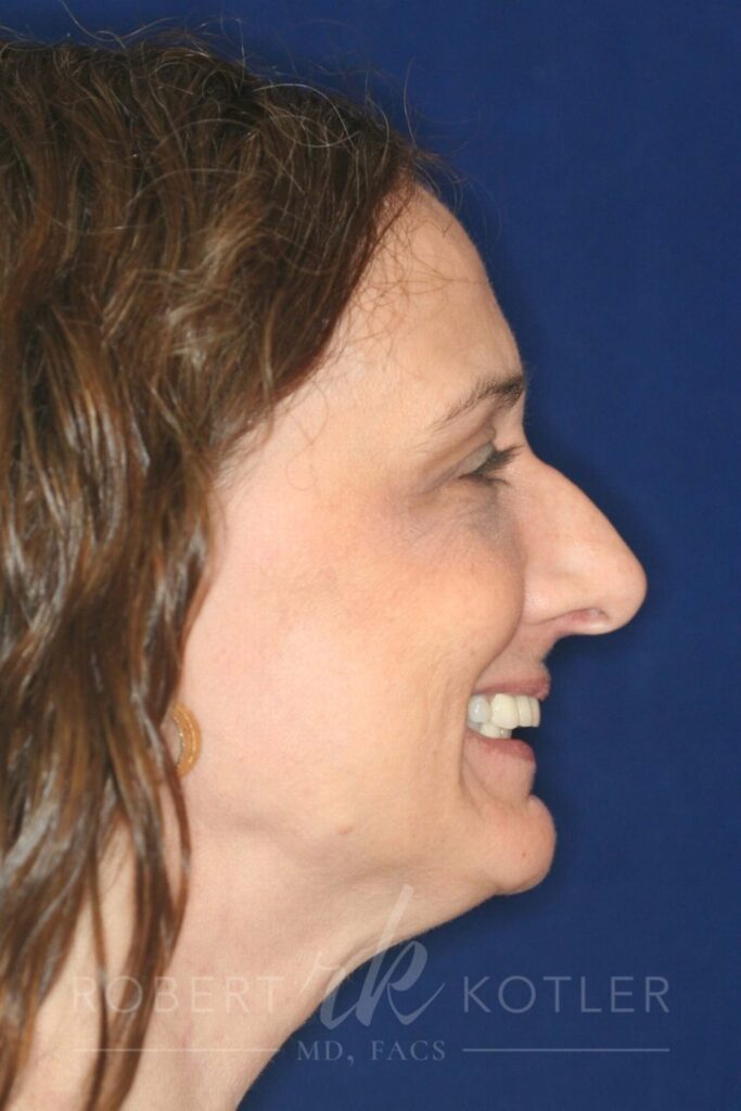 Closed Rhinoplasty - Right Profile - Before Pic - Bump to be removed and recess tip - Best Nose Job Surgeon