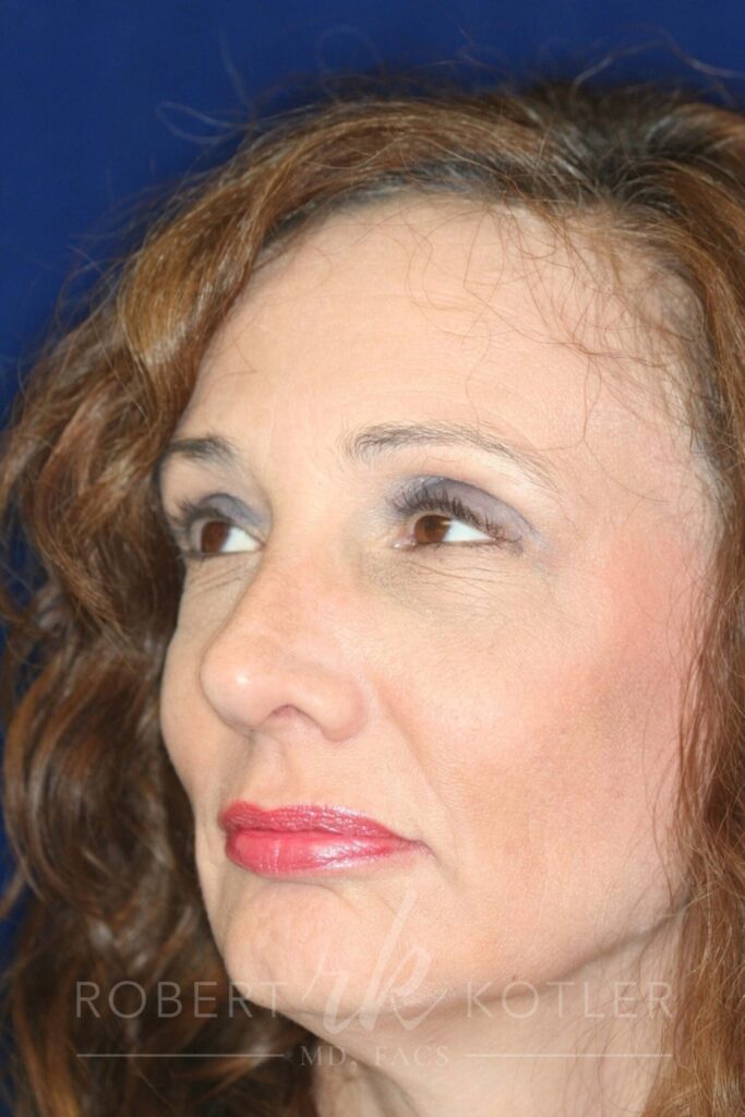 Closed Rhinoplasty - Left Front Facing - After Pic - Bump fully removed - Recessed and refined tip - Nose Job in Beverly Hills