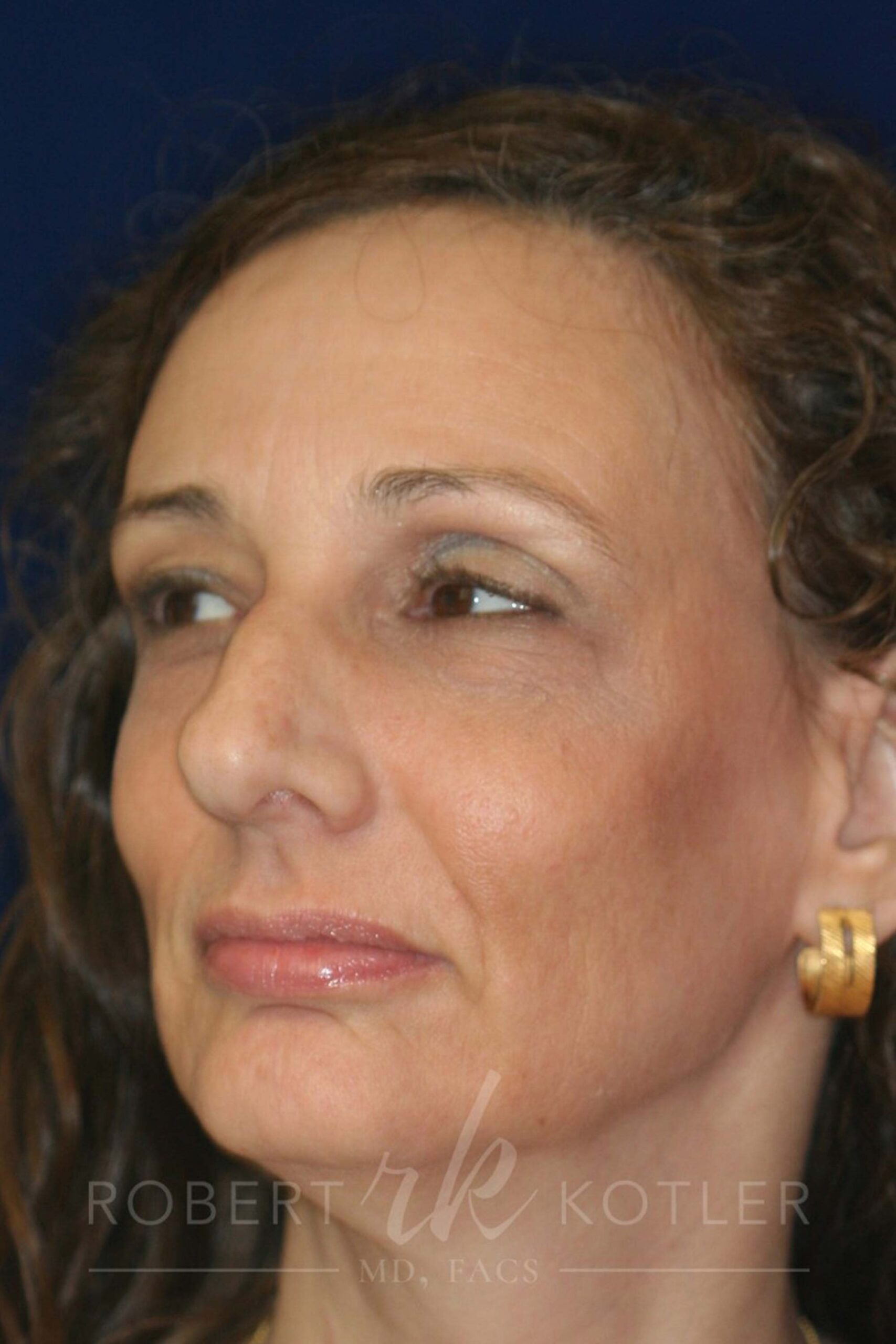 Closed Rhinoplasty - Left Front facing - Before Pic - Bump must be removed, recess the tip - Rhinoplasty Surgeon in Beverly Hills