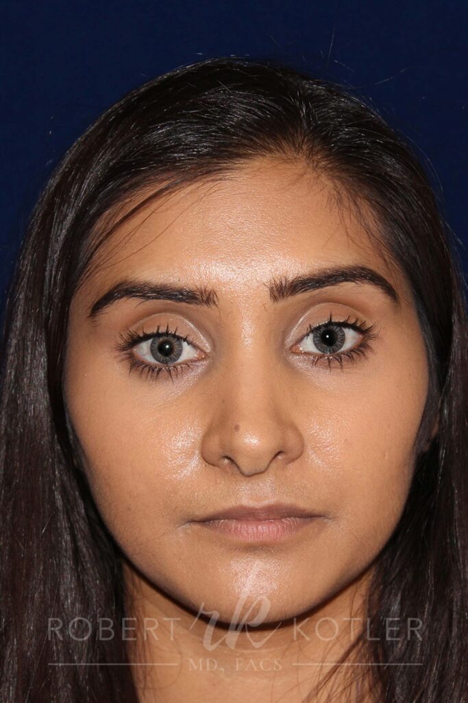 Closed Rhinoplasty - Front Face View - Before Pic - Correction of a bulging columella - Tip correction - Best Nose Job Surgeon