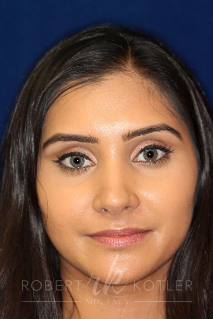Closed Rhinoplasty - Front Face View - After Pic - Correction of a bulging columella - Tip correction - Top Rhinoplasty Surgeon