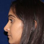 Closed Rhinoplasty - Left Profile - Before Pic - Correction of a bulging columella - Tip correction - Beverly Hills Rhinoplasty Superspecialist