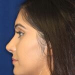 Closed Rhinoplasty - Left Profile - After Pic - Correction of a bulging columella - Tip correction - Best Rhinoplasty Beverly Hills