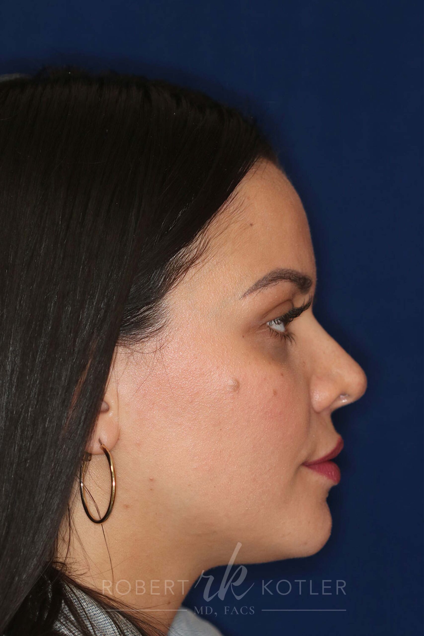Closed Rhinoplasty - Right Profile - After Pic - Hump removal - Nose tip refinement - Nose Job in Beverly Hills