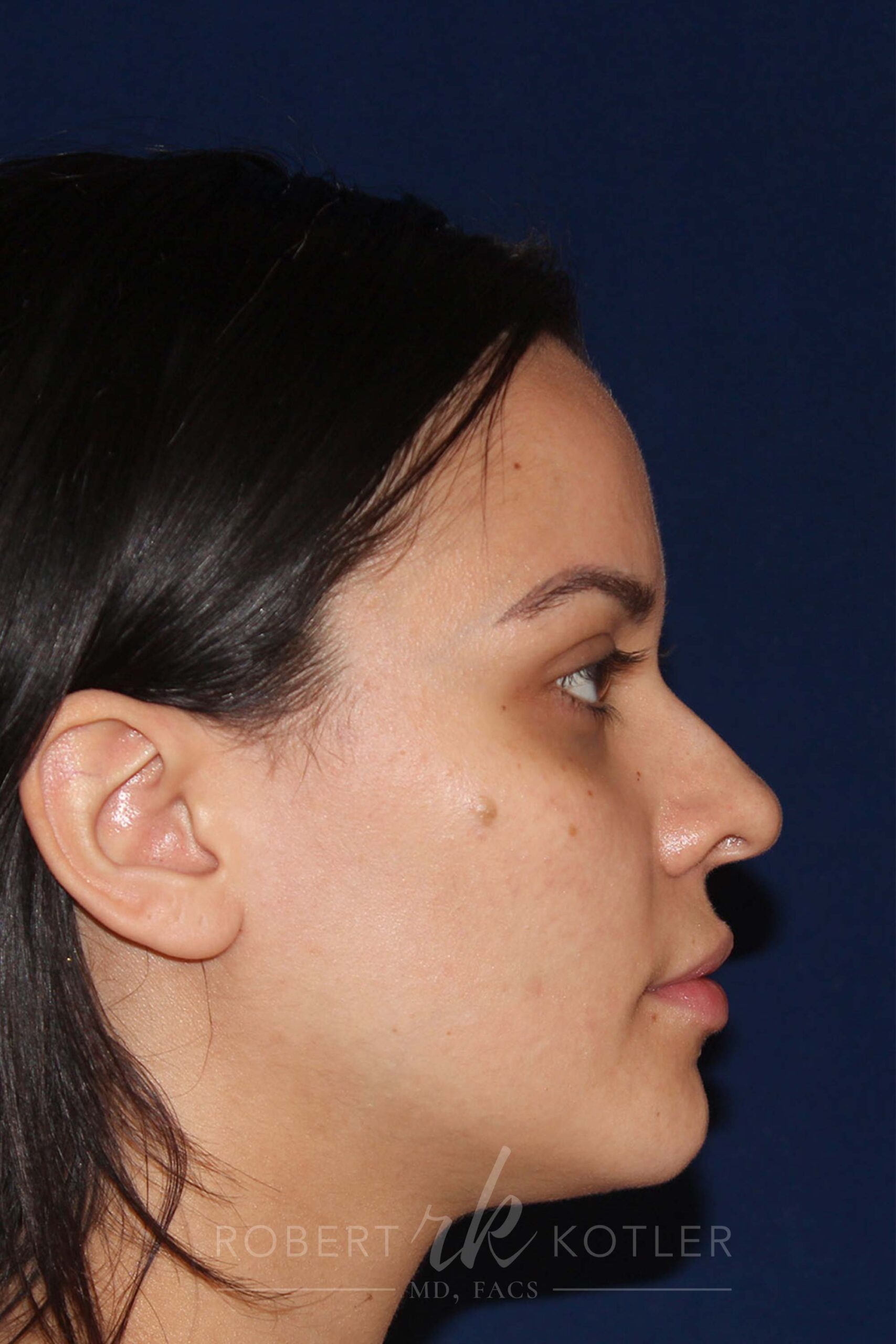 Closed Rhinoplasty - Right Profile - Before Pic - Hump removal - Nose tip refinement - Rhinoplasty Surgeon in Beverly Hills