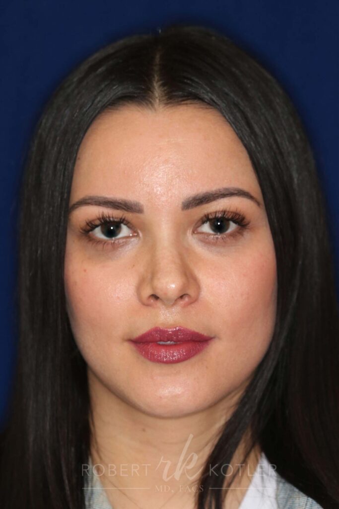 Closed Rhinoplasty - Front Face View - After Pic - Hump removal - Nose tip refinement - Best Rhinoplasty Beverly Hills