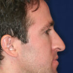 Closed Rhinoplasty - Right Profile - Before Pic - Hump Removal - Nose elevated from lip - Best Rhinoplasty Beverly Hills