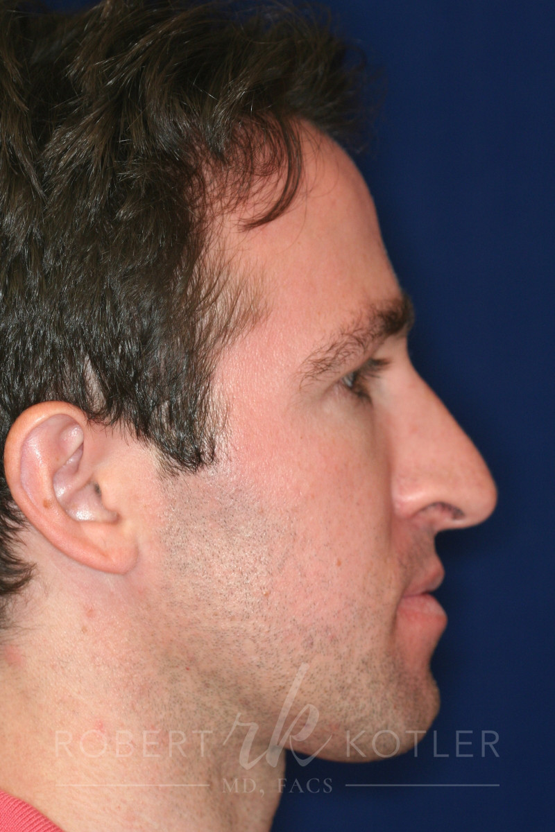 Closed Rhinoplasty - Right Profile - Before Pic - Hump Removal - Nose elevated from lip - Best Rhinoplasty Beverly Hills