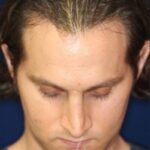 Permanent Non-surgical Rhinoplasty - Left Angled Profile - Before Pic - Correction of pinched tip - Nose tip refinement - Top Rhinoplasty Surgeon