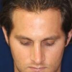 Permanent Non-surgical Rhinoplasty - Left Angled Profile - Before Pic - Correction of pinched tip - Nose tip refinement - Top Rhinoplasty Surgeon