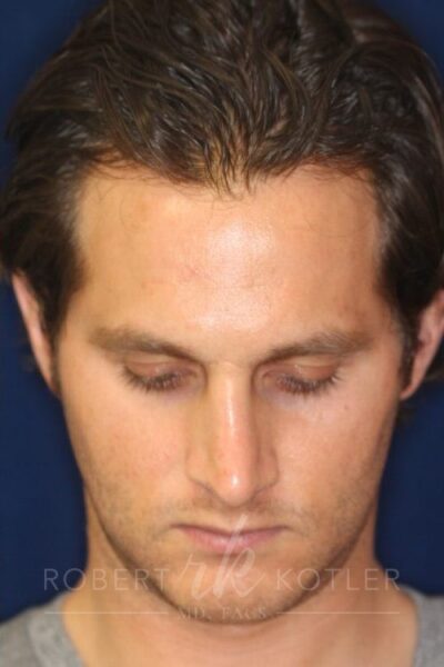 Permanent Non-surgical Rhinoplasty - Left Angled Profile - Before Pic - Correction of pinched tip - Nose tip refinement - Top Rhinoplasty Surgeon