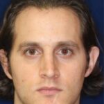 Permanent Non-surgical Rhinoplasty - Left Angled Profile - Before Pic - Correction of pinched tip - Nose tip refinement - Top Rhinoplasty Surgeon