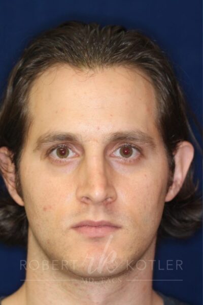 Permanent Non-surgical Rhinoplasty - Left Angled Profile - Before Pic - Correction of pinched tip - Nose tip refinement - Top Rhinoplasty Surgeon