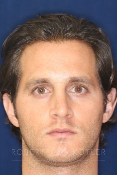 Permanent Non-surgical Rhinoplasty - Left Angled Profile - Before Pic - Correction of pinched tip - Nose tip refinement - Top Rhinoplasty Surgeon
