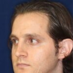 Permanent Non-surgical Rhinoplasty - Left Angled Profile - Before Pic - Correction of pinched tip - Nose tip refinement - Top Rhinoplasty Surgeon