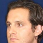 Permanent Non-surgical Rhinoplasty - Left Angled Profile - Before Pic - Correction of pinched tip - Nose tip refinement - Top Rhinoplasty Surgeon