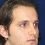 Permanent Non-surgical Rhinoplasty - Left Angled Profile - Before Pic - Correction of pinched tip - Nose tip refinement - Top Rhinoplasty Surgeon