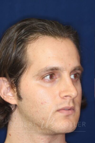 Permanent Non-surgical Rhinoplasty - Left Angled Profile - Before Pic - Correction of pinched tip - Nose tip refinement - Top Rhinoplasty Surgeon