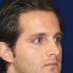 Permanent Non-surgical Rhinoplasty - Left Angled Profile - Before Pic - Correction of pinched tip - Nose tip refinement - Top Rhinoplasty Surgeon