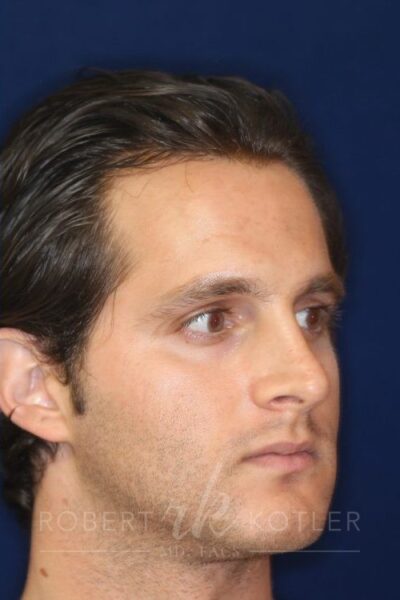 Permanent Non-surgical Rhinoplasty - Left Angled Profile - Before Pic - Correction of pinched tip - Nose tip refinement - Top Rhinoplasty Surgeon