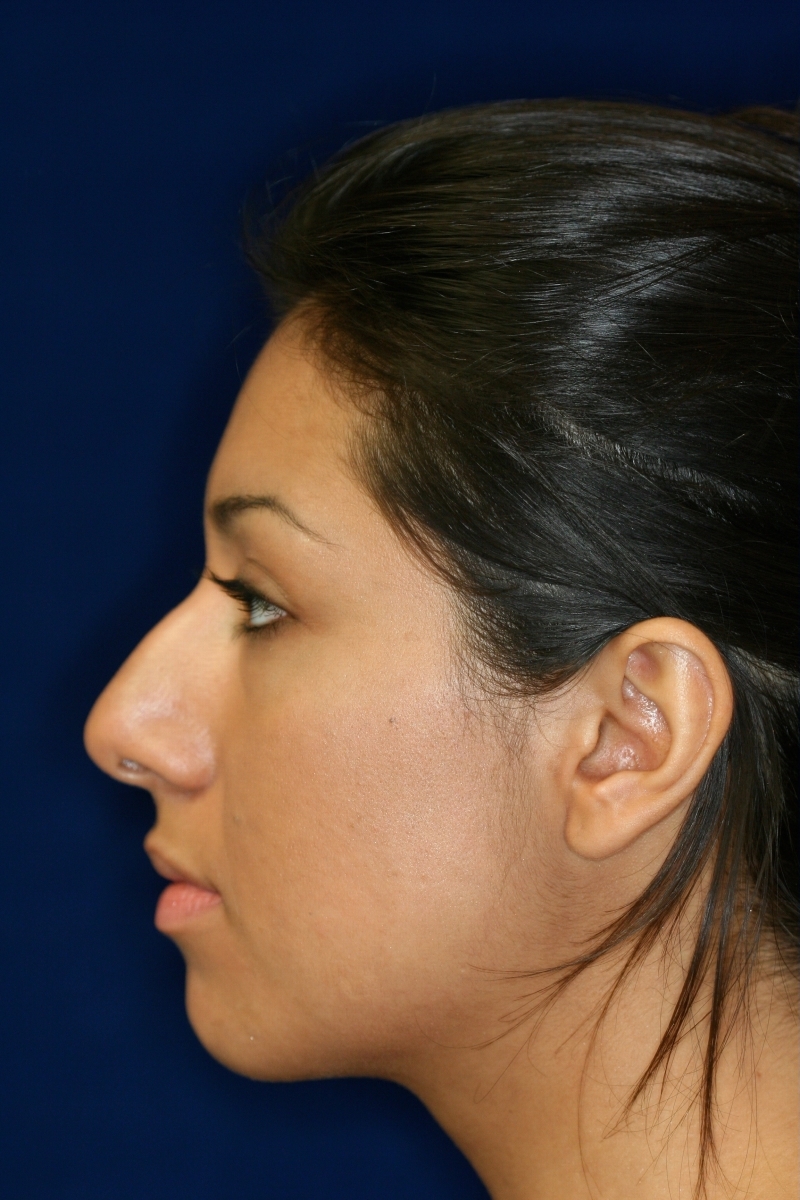 Closed Rhinoplasty -Left Profile - Before Pic - Hump removal - Tip refinement - Rhinoplasty Surgeon in Beverly Hills