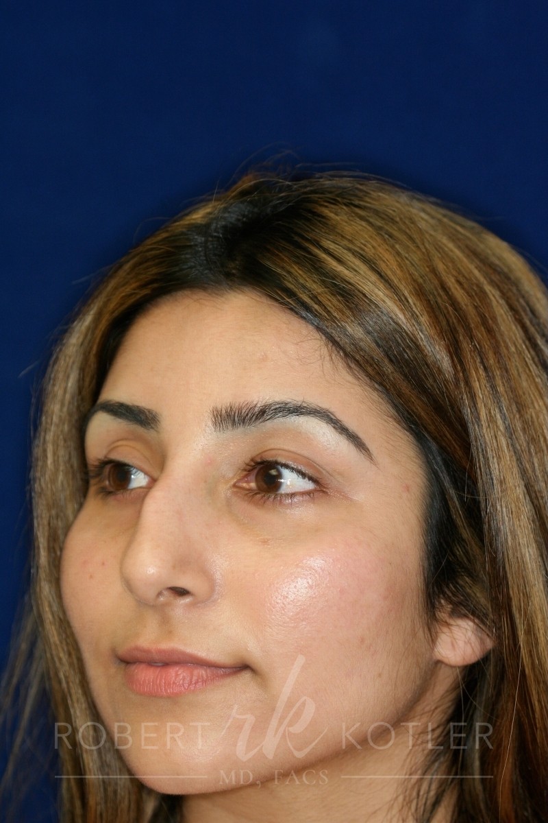 Closed Rhinoplasty - Left Angle Profile - Before Pic - Hump removal - Tip refinement - Nose recessed closer to the face - Beverly Hills Rhinoplasty Superspecialist