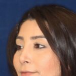 Closed Rhinoplasty - Left Angle Profile - After Pic - Hump removal - Tip refinement - Nose recessed closer to the face - Best Rhinoplasty Beverly Hills