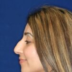 Closed Rhinoplasty - Left Profile - Before Pic - Hump removal - Tip refinement - Nose recessed closer to the face - Rhinoplasty Surgeon in Beverly Hills