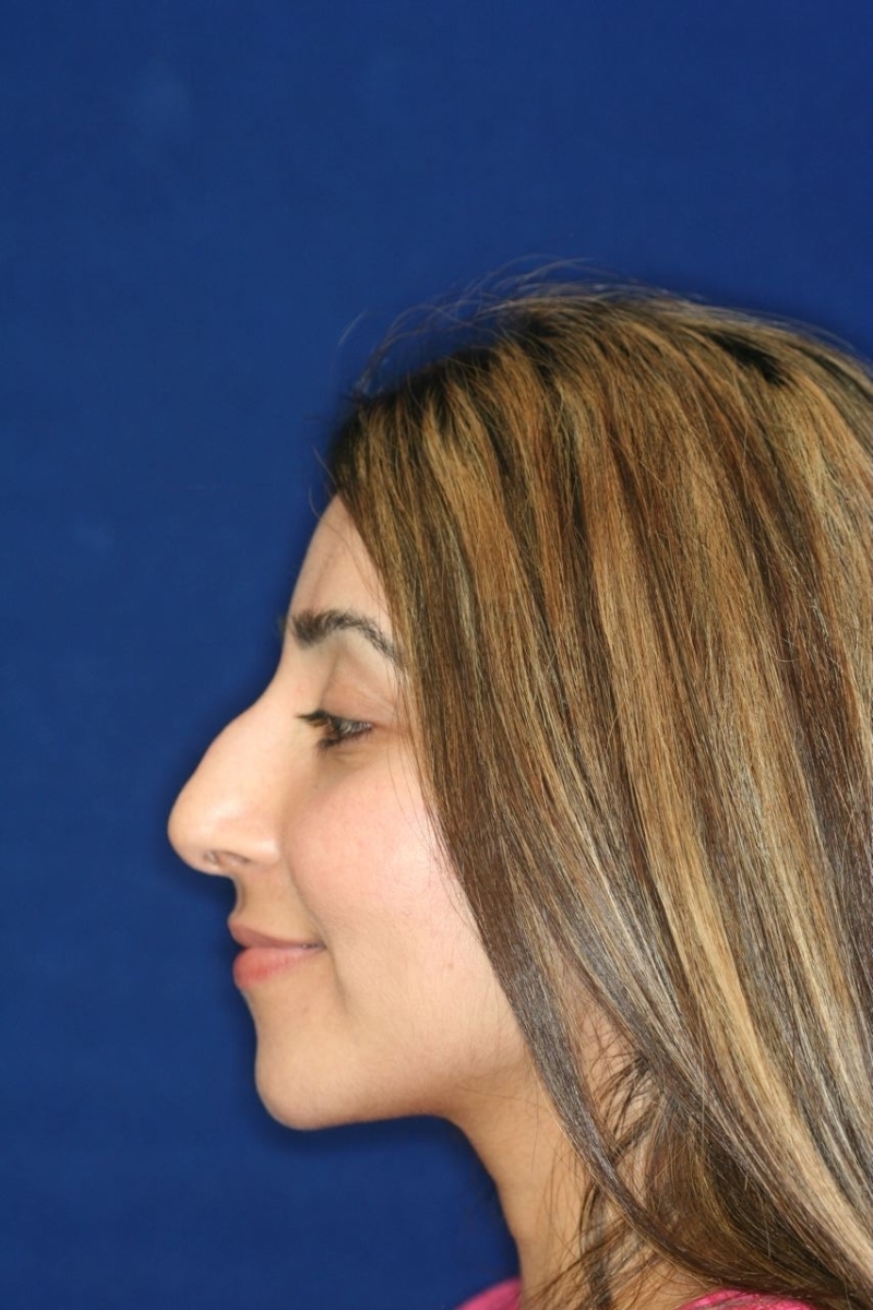 Closed Rhinoplasty - Left Profile - Before Pic - Hump removal - Tip refinement - Nose recessed closer to the face - Rhinoplasty Surgeon in Beverly Hills