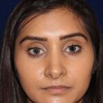 Closed Rhinoplasty - Front Face View - Before Pic - Correction of a bulging columella - Tip correction - Best Nose Job Surgeon