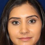 Closed Rhinoplasty - Front Face View - After Pic - Correction of a bulging columella - Tip correction - Top Rhinoplasty Surgeon