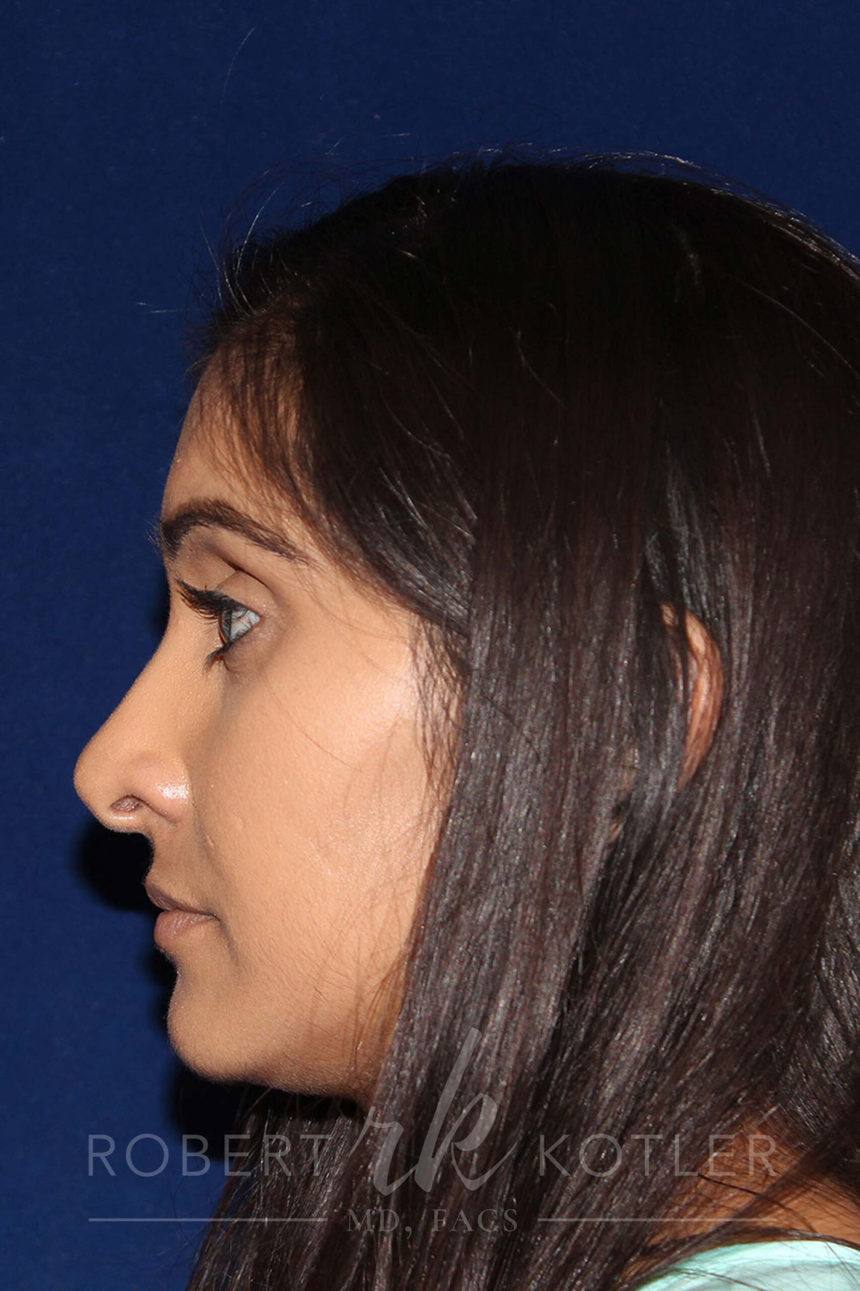 Closed Rhinoplasty - Left Profile - Before Pic - Correction of a bulging columella - Tip correction - Beverly Hills Rhinoplasty Superspecialist