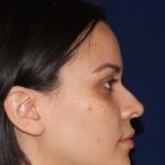 Closed Rhinoplasty - Right Profile - Before Pic - Hump removal - Nose tip refinement - Rhinoplasty Surgeon in Beverly Hills