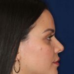 Closed Rhinoplasty - Right Profile - After Pic - Hump removal - Nose tip refinement - Nose Job in Beverly Hills