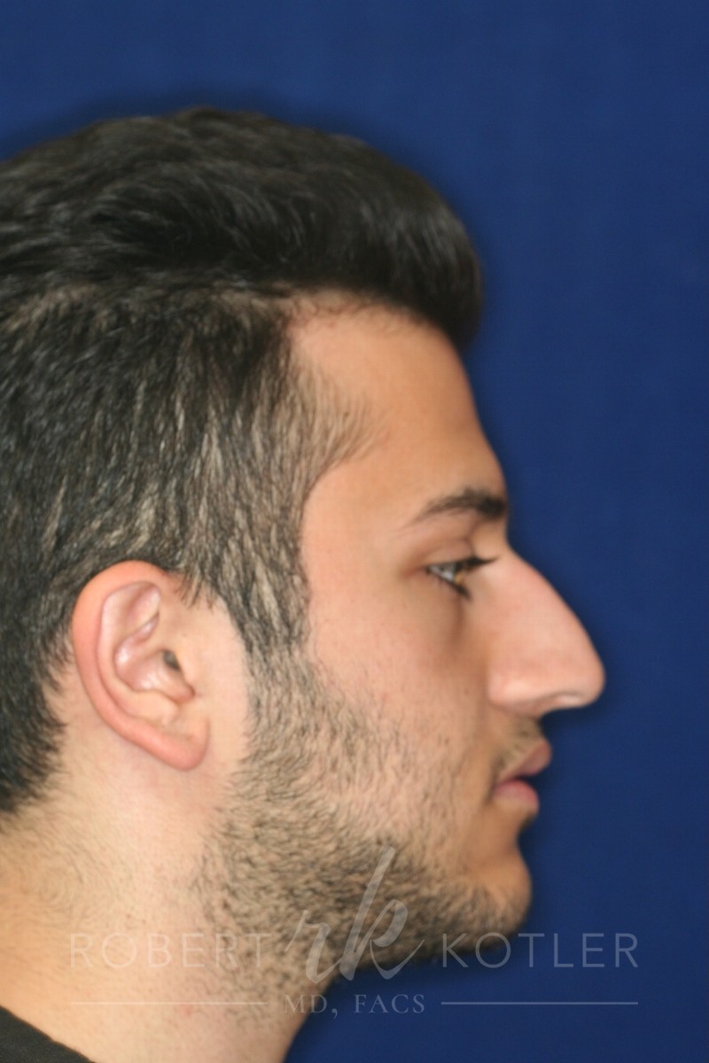 Closed Rhinoplasty - Right Profile - Before Pic - Lowering of the bridge - Nose recessed closer to the face - Best Nose Job Surgeon