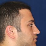 Closed Rhinoplasty - Right Profile - After Pic - Lowering of the bridge - Nose recessed closer to the face - Top Rhinoplasty Surgeon