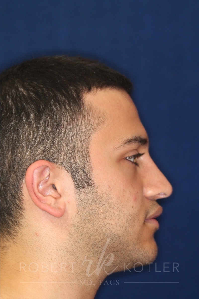 Closed Rhinoplasty - Right Profile - After Pic - Lowering of the bridge - Nose recessed closer to the face - Top Rhinoplasty Surgeon