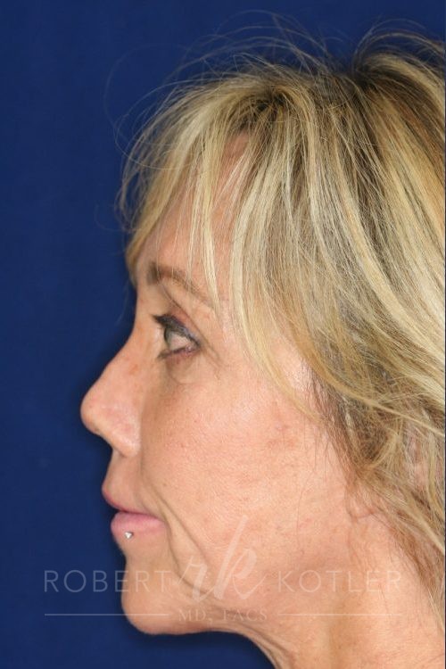 Permanent Non-surgical Revision Rhinoplasty - Left Profile - Before Pic - Correction of irregular bridge - Amputated columella restored - Natural tip restored - Best Nose Job Surgeon
