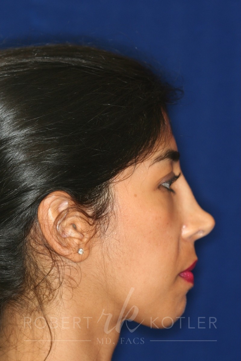 Permanent Non-surgical Revision Rhinoplasty - Right Profile - Before Pic - Correction of irregular bridge - Natural tip restored - Beverly Hills Rhinoplasty Superspecialist