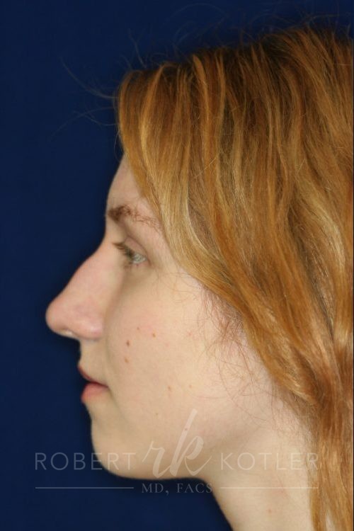 Permanent Non-surgical Rhinoplasty - Left Profile - Before Pic - Permanent filler - Hump removal - Tip and bridge refinement - Best Rhinoplasty Beverly Hills