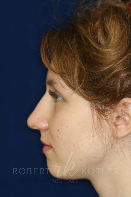 Permanent Non-surgical Rhinoplasty - Left Profile - After Pic - Permanent filler - Hump removal - Tip and bridge refinement - Rhinoplasty Surgeon in Beverly Hills