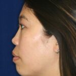 Permanent non-surgical rhinoplasty - Left Profile - After Pic - Permanent filler - Pre-injury appearance restored - Best Nose Job Surgeon